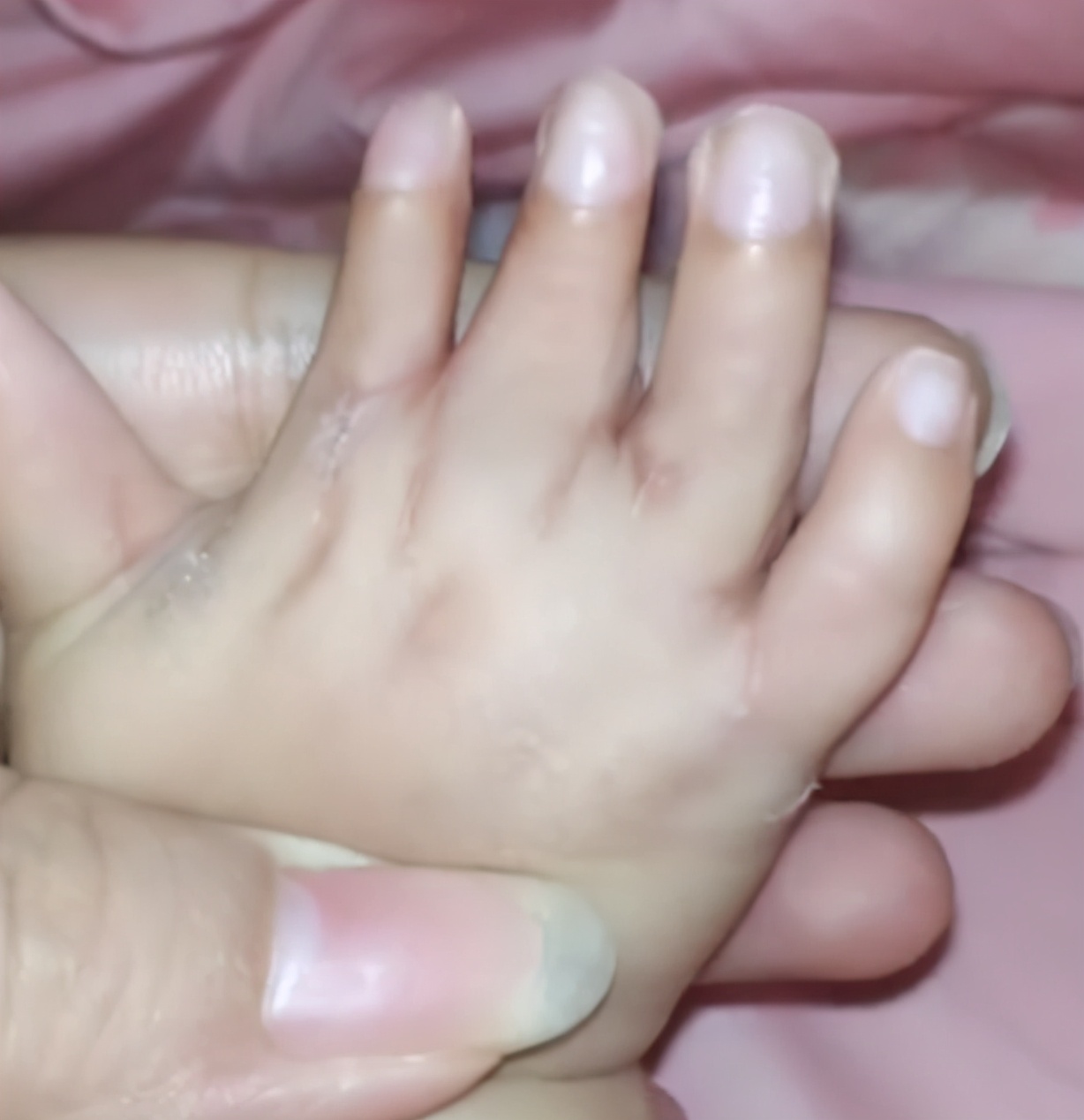 并指畸形免植皮案例,并指畸形