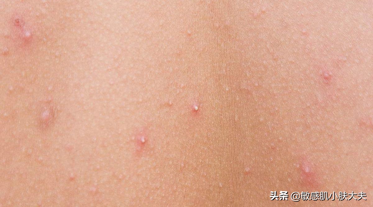 阿达帕林怎么用才正确,阿达帕林怎么用不烂脸