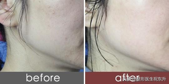 测评｜天天敷面膜和1个月打1次水光针，哪个效果好？