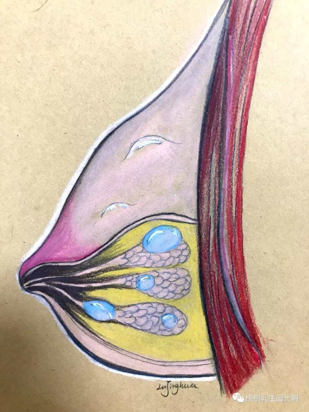 乳腺囊肿是什么意思严重吗,乳腺囊肿的由来