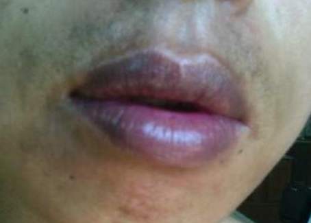 为啥有些人嘴唇比较紫正常,有的人嘴唇发紫是什么原因