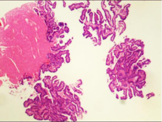 查出来“甲状腺癌”，还能活多久？最详细的治疗介绍如下
