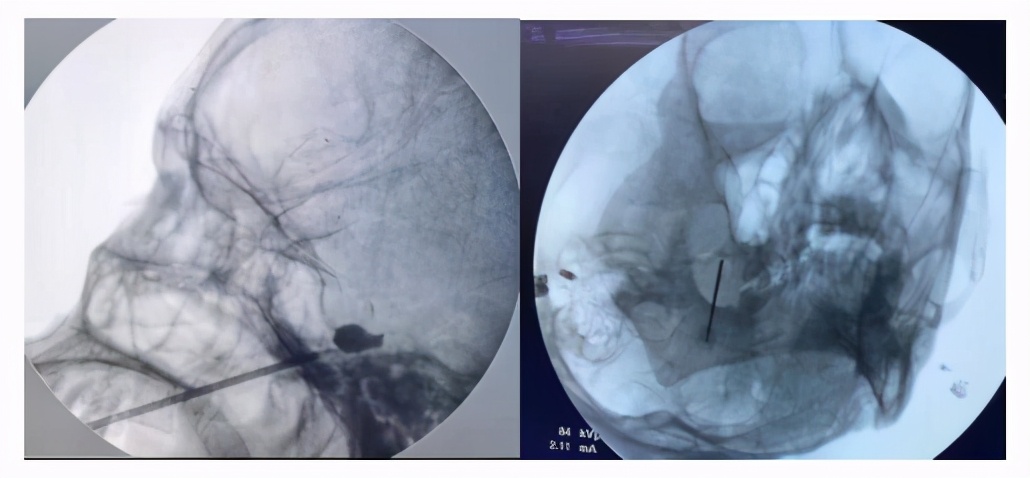 赶走疼痛,一身轻松!腰背痛,太原市中心医院疼痛科有妙招