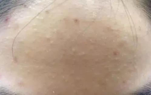 长闭口的正确消除方法新手入门,干货满满一段话