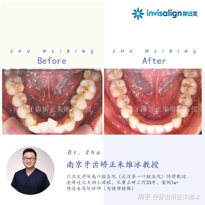 牙齿歪矫正,南京成人牙齿矫正牙齿不齐