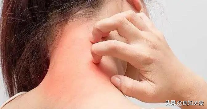 注射胰岛素的部位痒怎么办,胰岛素过敏瘙痒是否要停用