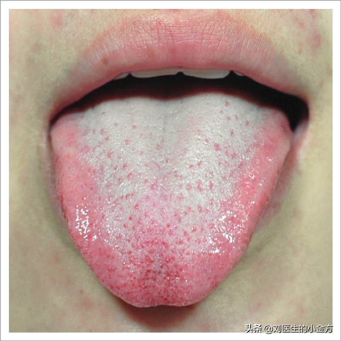 中医舌诊图解100例,中医舌诊图与舌诊口诀
