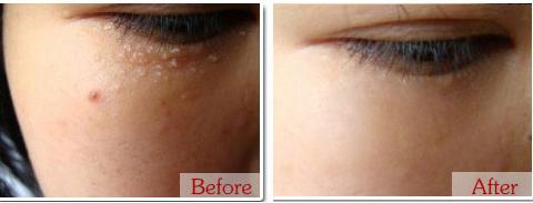 脂肪粒去粒神器 (日本自动消除脂肪粒)