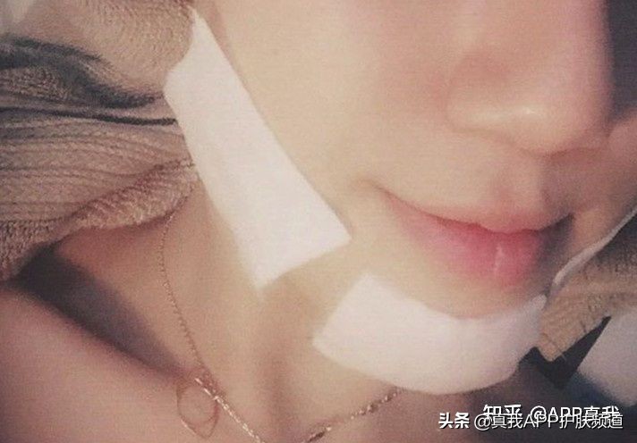 敏感肌刷酸刷多了会变成怎样,敏感肌刷酸后皮肤变红