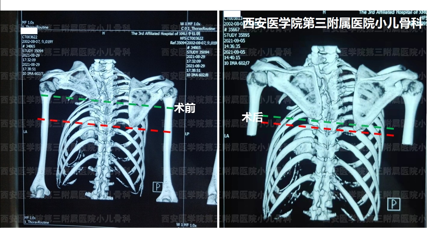 先天性高肩胛手术,先天性肩胛症通过手术需要多少钱