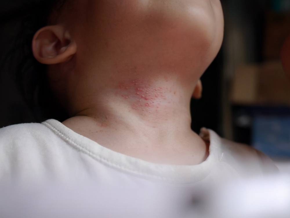 夏季宝宝身上擦爽身粉,宝宝身上痱子痒怎么解决