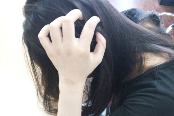 头皮和后背起疙瘩瘙痒是怎么回事,头皮上有个小疙瘩抠掉还会长