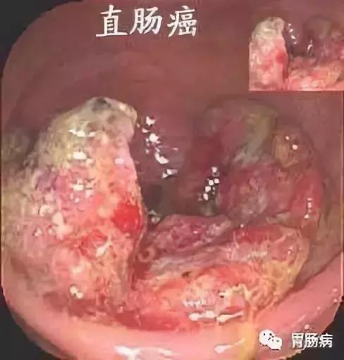 直肠癌内痔可以误诊吗,直肠癌误诊为痔疮的原因是什么