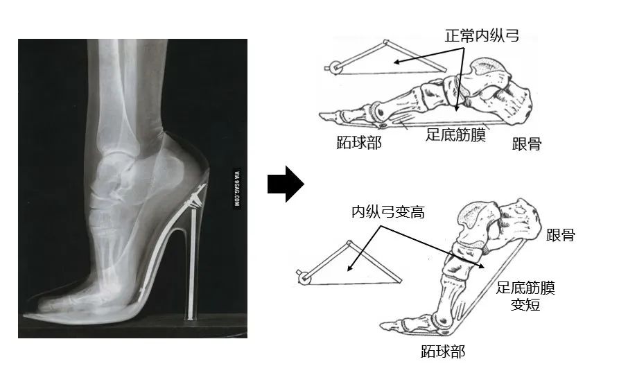 为了美，你愿意上麻药穿红色高跟鞋吗？