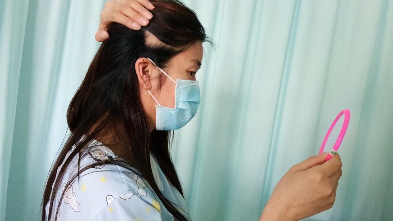 脱发大部分都是什么类型的脱发,脱发的最新标准治疗方法