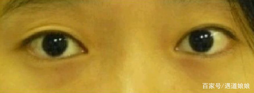 黑眼圈的自救指南有哪些,黑眼圈自救指南看这里