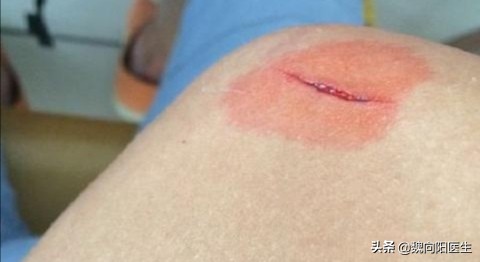 伤口打破伤风针就不会感染吗,伤口接触土壤会感染破伤风吗