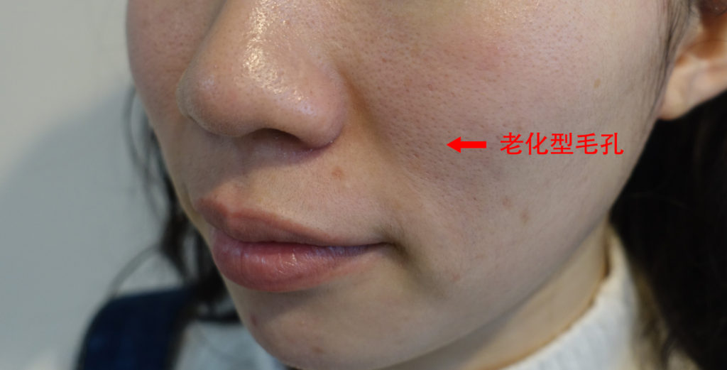 毛孔缩小的过程图,鼻子毛孔怎么缩小