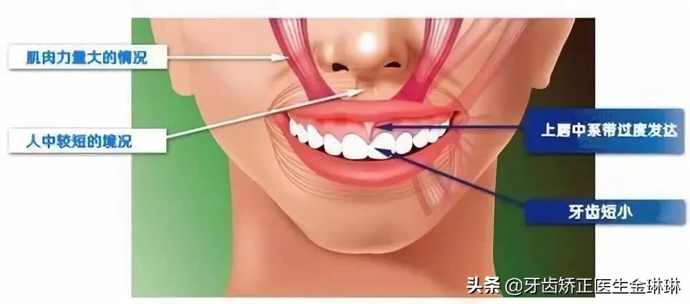 成年人露龈笑怎么矫正,如何矫正露龈笑嘴突