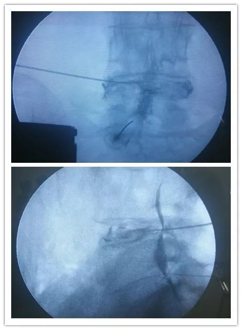 疼痛科一般怎么解决疼痛,什么样的疼痛要到疼痛科诊疗