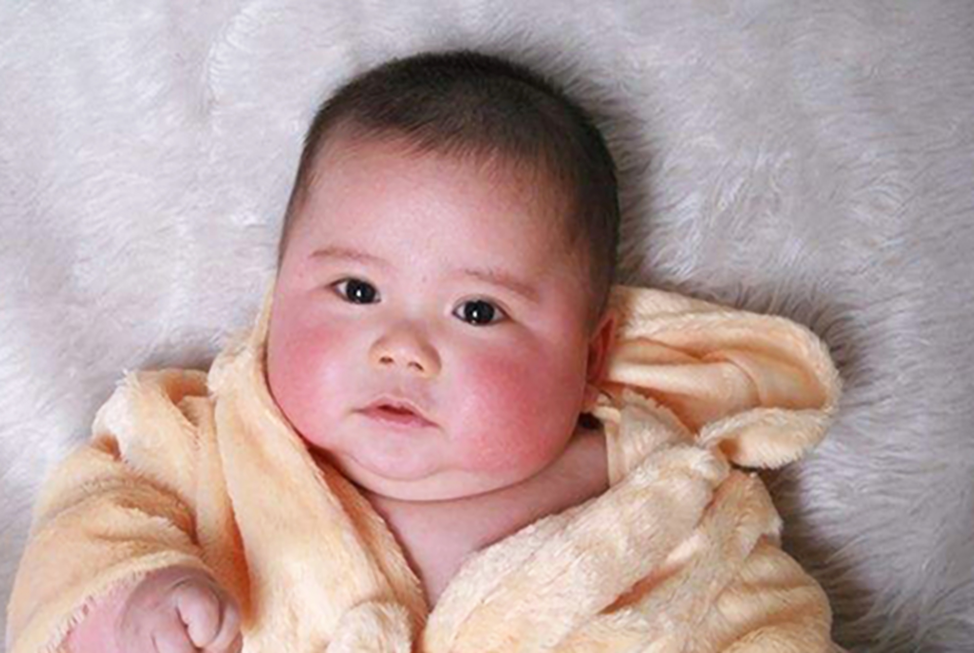 红脸蛋宝宝霜修复,宝宝脸冻伤了发红擦什么