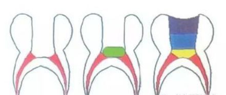 盖髓术步骤,盖髓术是什么意思