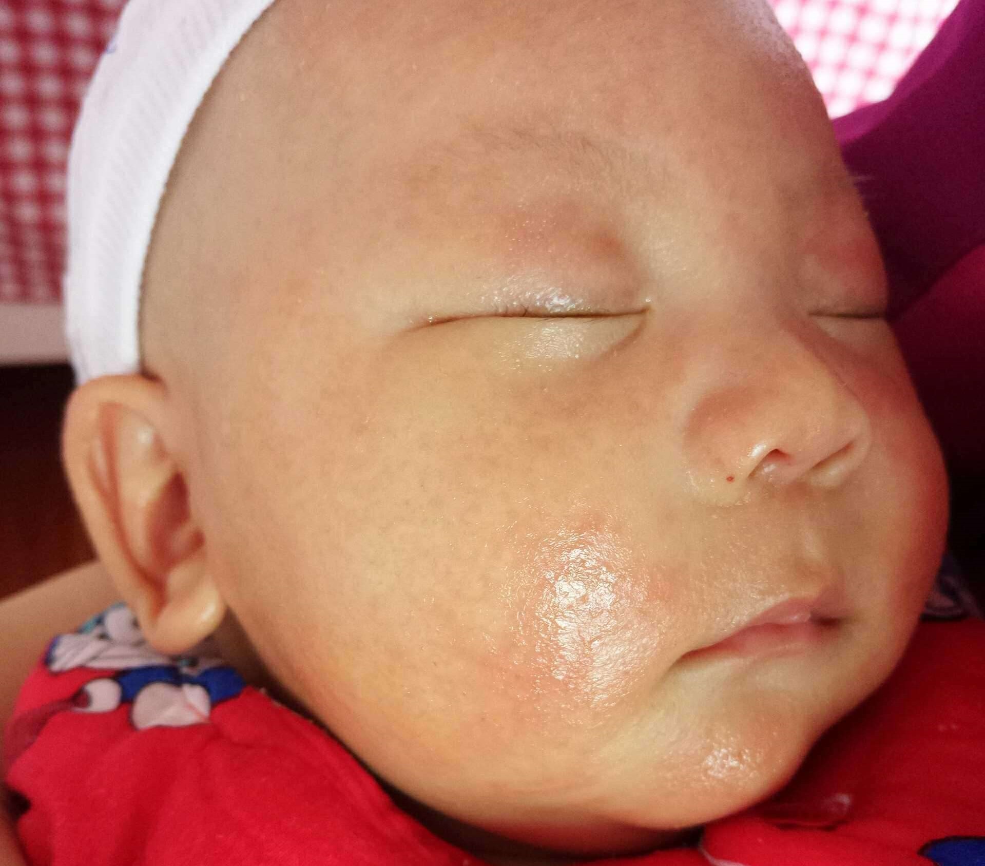 宝宝湿疹反复怎么办教你一招去除,宝宝的湿疹一直反复发作怎么办