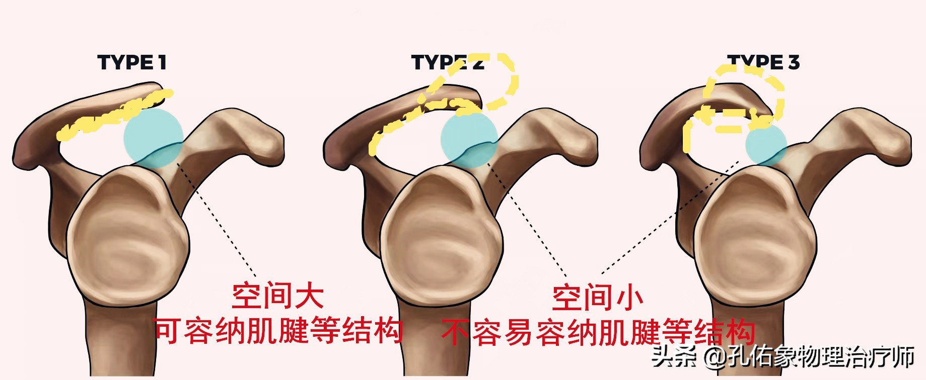 肩周炎肩膀疼是什么原因造成,肩周炎导致的肩膀疼痛怎么缓解