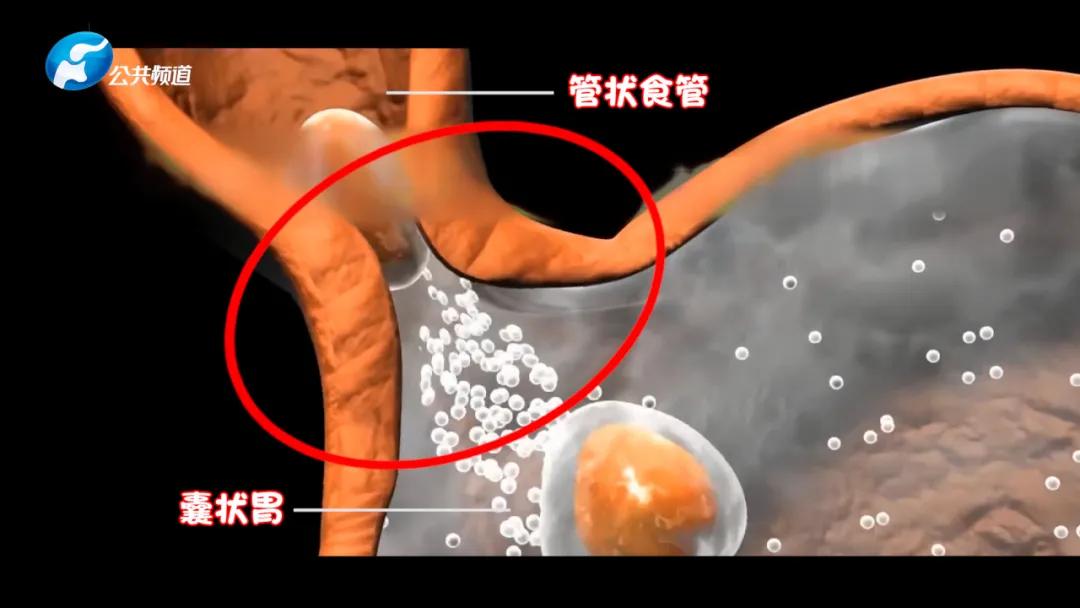 转移性食管胃结合部治疗进展,单孔纵隔镜食管癌根治术文献