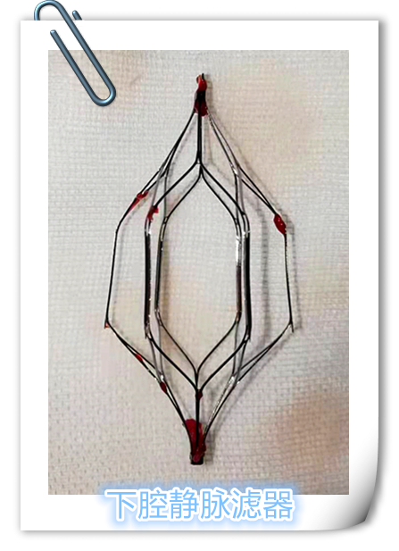 急性肺栓塞的中医操作,肺栓塞微创介入取栓