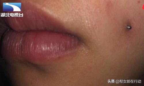 19岁女子打钢钉“种”酒窝，不料遇上庸医，感染发炎差点毁容