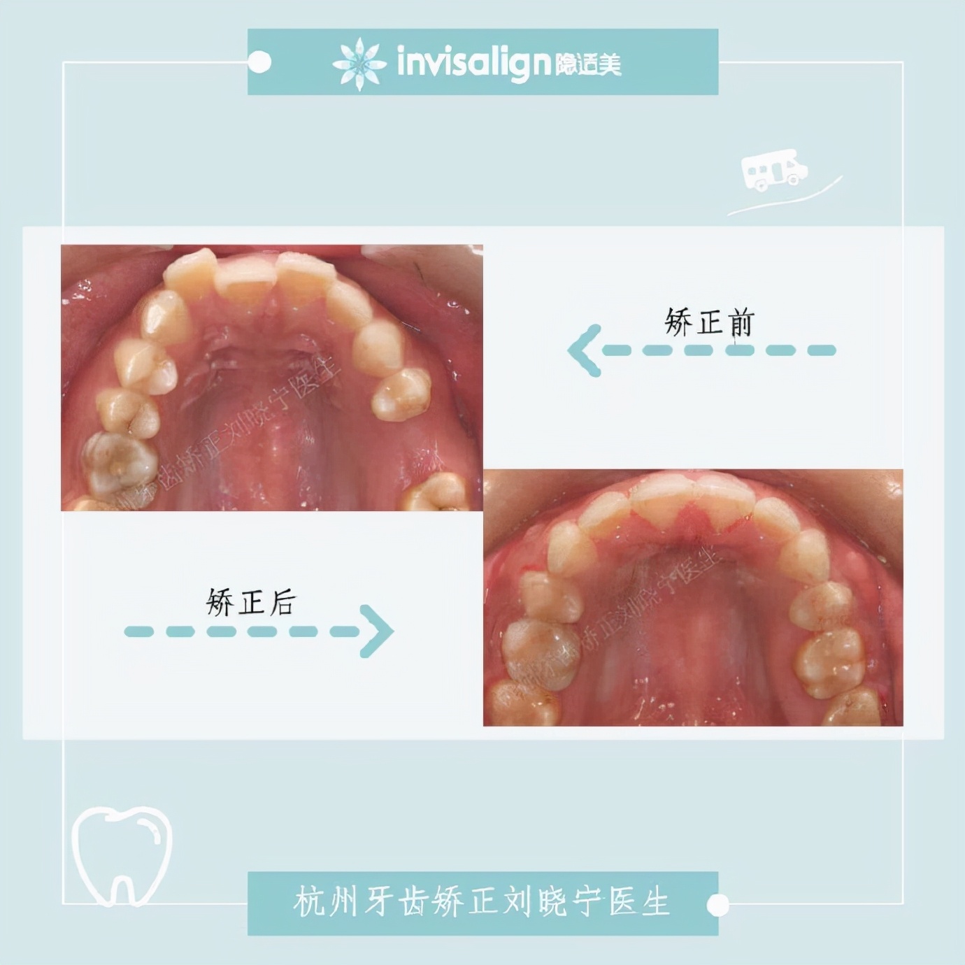 矫正牙齿如何改善露龈笑,矫正牙齿可以改善露龈笑吗