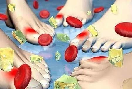 痛风发作期苯溴马隆的正确吃法,急性痛风发作期能吃苯溴马隆吗