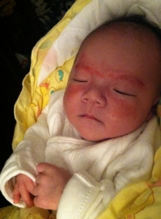 渗出性湿疹的症状和表现,小儿湿疹症状表现有哪些