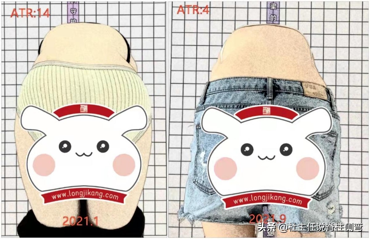 14岁女孩侧弯治疗一年后,12岁女孩脊柱s型侧弯17度怎么治