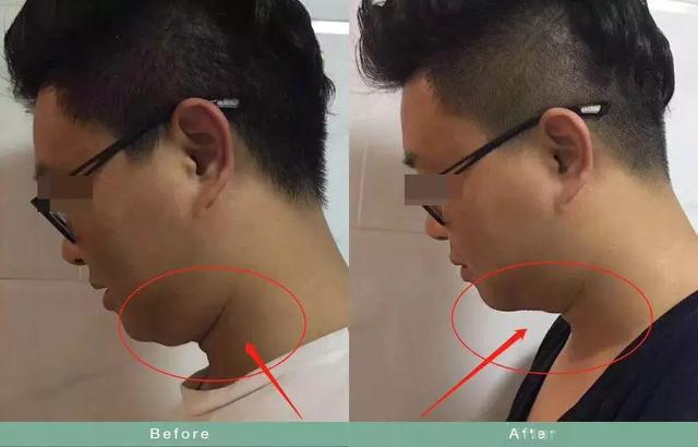 如何瘦双下巴和婴儿肥,小孩怎么快速减掉双下巴