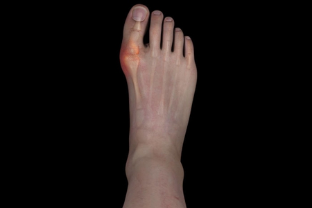 痛风治疗三剑客你了解多少,痛风分期是几期