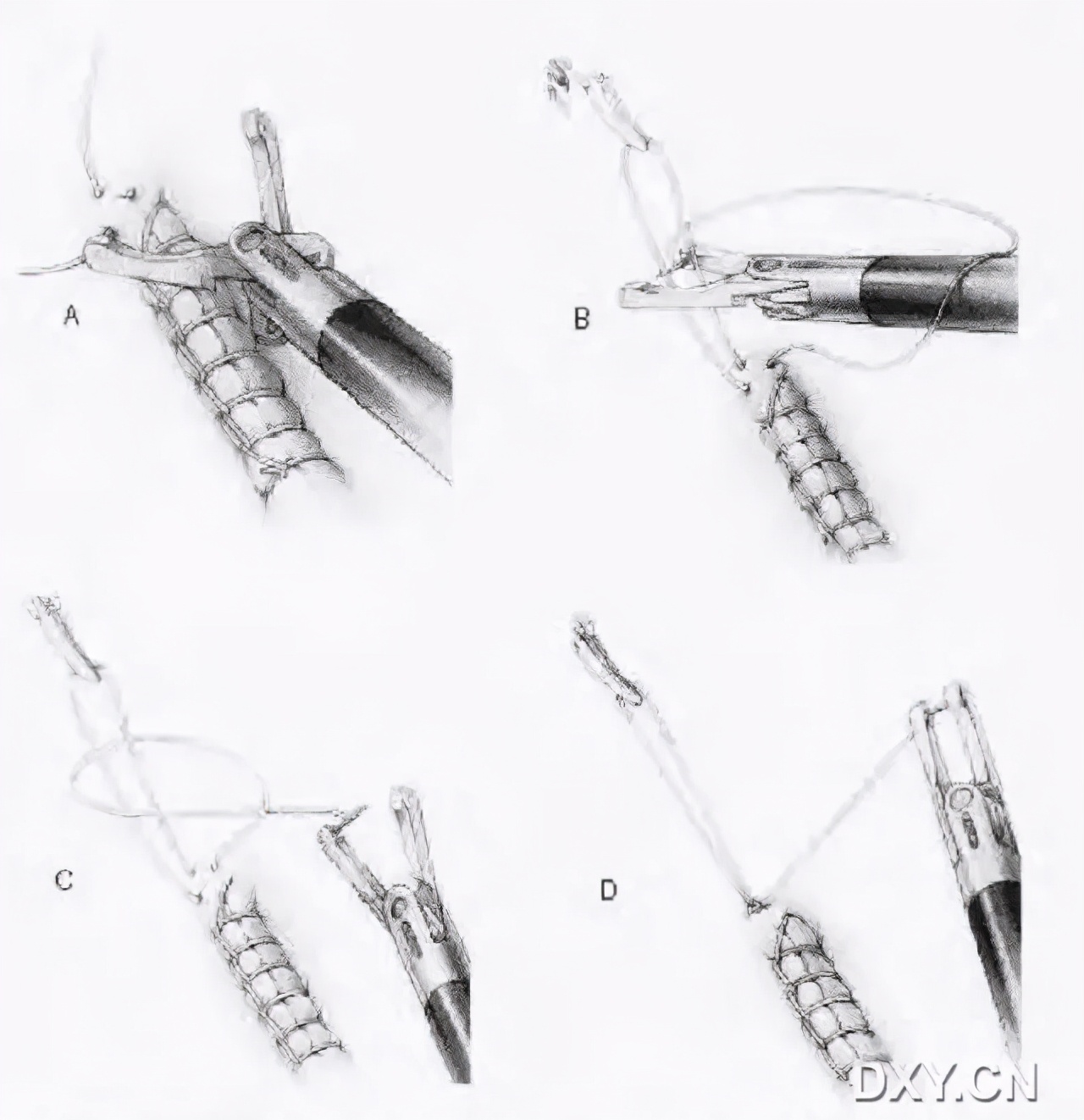 腹腔镜下切割缝合器使用视频,腹腔镜下缝合教程