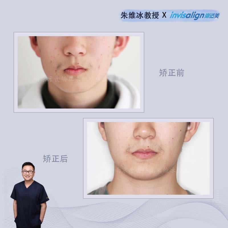 隐适美牙齿拥挤矫正真实案例,南京朱维冰