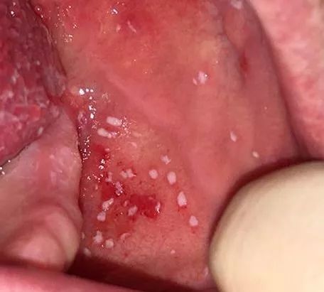 近期儿童流行疾病,儿童常见的疾病预防知识