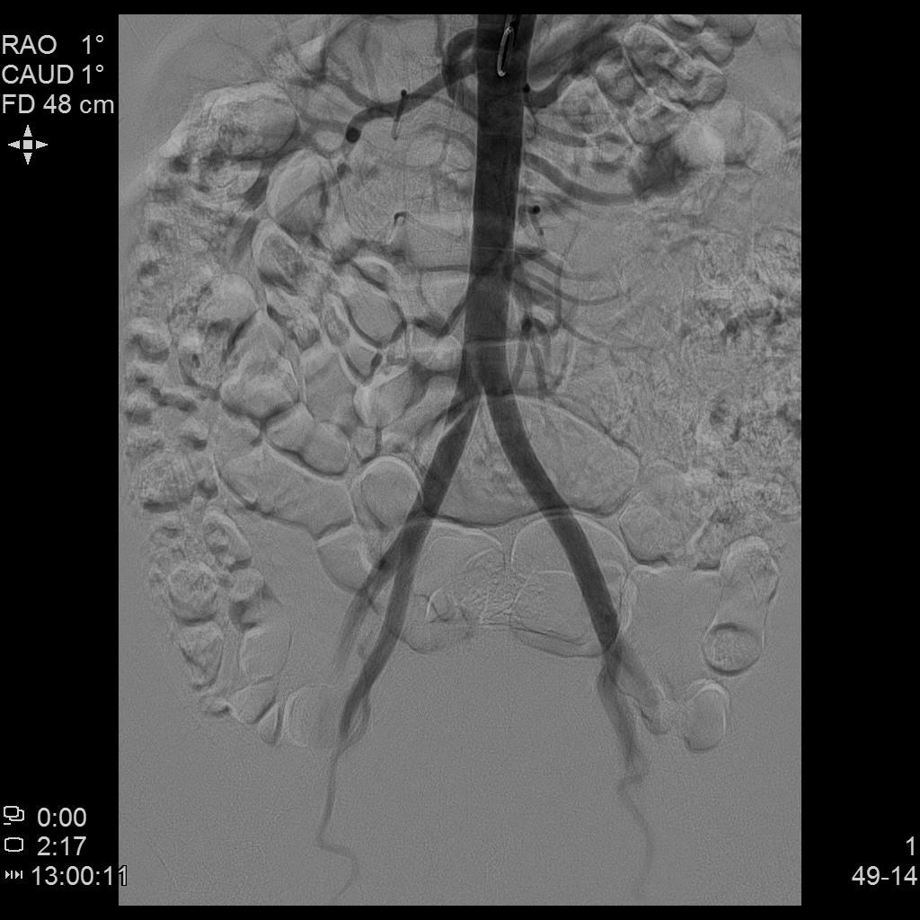 子宫腺肌症称为不死的癌症,子宫腺肌症是不死的癌症吗