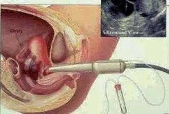 阴超和腹式B超有什么区别？