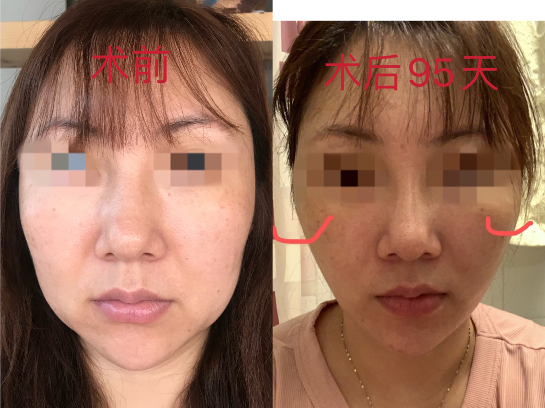 42岁做拉皮还是线雕,做线雕一年后可以做拉皮术吗