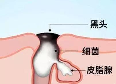 人人都会长黑头吗,好多人都长黑头吗