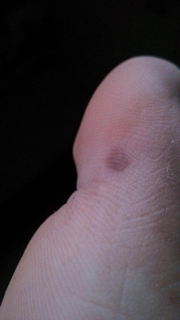 街上点痣10元可靠吗,路边点痣真的可靠吗