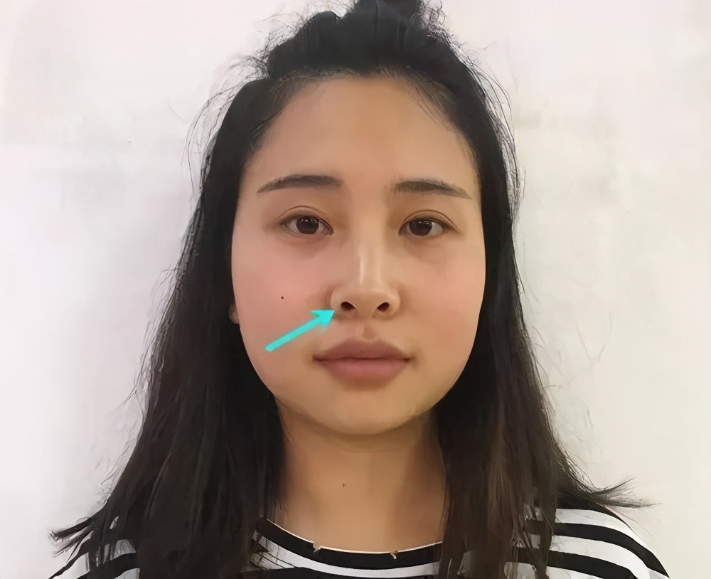 鼻头圆润鼻孔外露怎么改善,鼻孔外露土气怎么改善