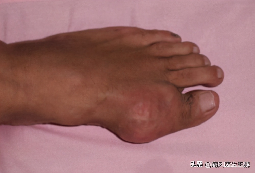 家族有痛风史如何避免痛风,张景明一病一讲痛风如何治疗