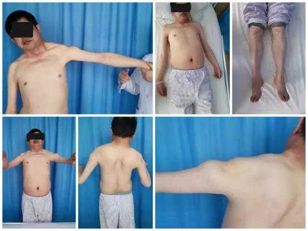 康庄大道伴你前行——进行性肌营养不良的治疗