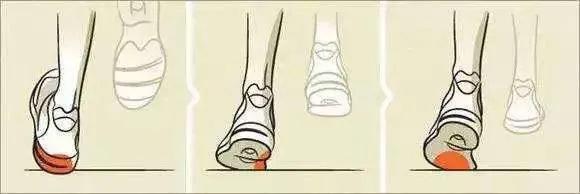 关注“跑偏”的鞋子，提示你的健康问题！