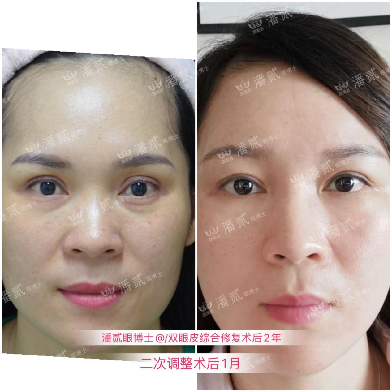 双眼皮太深显老怎么修复,双眼皮失败后修窄